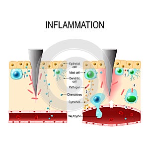 Inflammation. Immune system