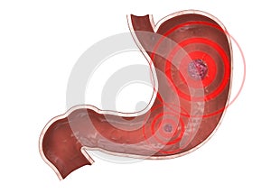 Inflammation stomach
