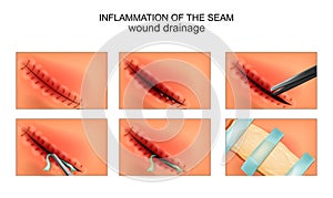 Inflammation of the surgical site. wound drainage