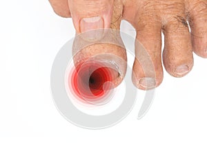 Inflammation at the tip of toenail. Concept of paronychia at big toe of Asian man. Painful toe photo