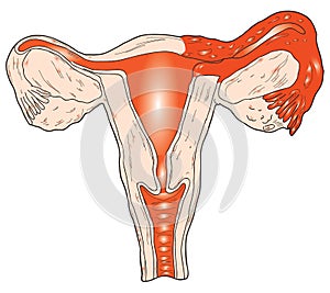 Inflammation of the uterus