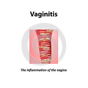 Inflammation of the vagina. Vaginitis. Infographics. Vector illustration on background