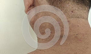 Inflammatory acne on the back is attached to the nape of the male..