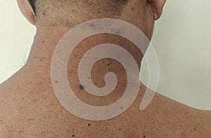 Inflammatory acne on the back is attached to the nape of the male..