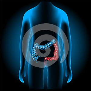 Inflammatory bowel disease