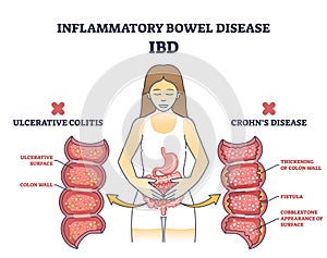 Inflammatory bowel disease or IBD with Crohns and colitis outline diagram