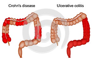 Inflammatory bowel disease. large intestine. Crohn disease and Ulcerative colitis
