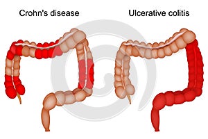 Inflammatory bowel disease. large intestine. Crohn disease and Ulcerative colitis photo