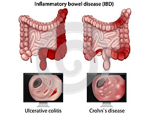 Inflammatory bowel disease medical  illustration on white background photo