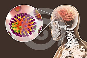 Influenza complication encephalitis