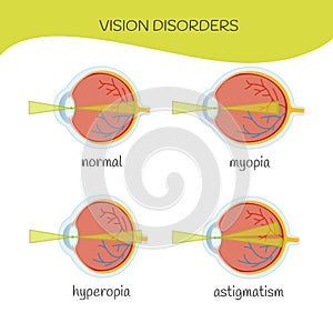 Infografica eyes disease