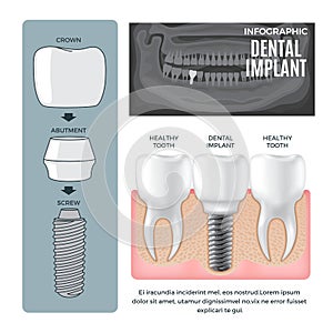 Infographic Dental Implant Structure Info Poster