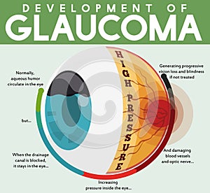 Infographic with Development of Untreated Glaucoma Disease, Vector Illustration