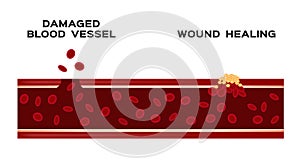 Infographic of how blood vessel heal itself