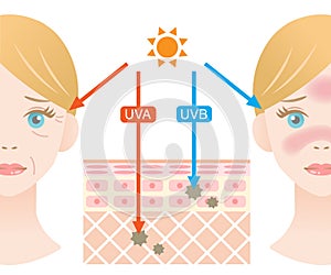 Infographic skin illustration. the difference between UVA and UVB rays penetration photo