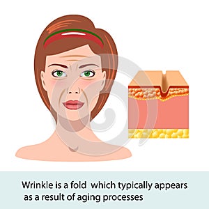 Infographic skin illustration. Wrinkle, change of the face, vector