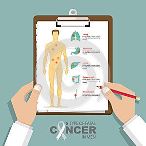 Infographic for top 5 type of fatal cancer in men in flat design. Clipboard in doctor hand. Medical and health care report.