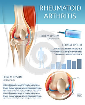 Infographic Treatment Method Rheumatoid Arthritis