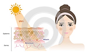 Infographic UVA rays penetrate into the skin layer, damage woman face with melasma, aging, wrinkle, dark spots vector.