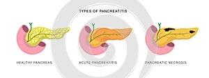 Infographics demonstrating the difference of pancreatitis and pancreatic necrosis Disease diagnostic procedure
