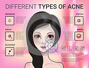 Infographics of different type of skin acne