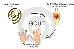 Infographics for disease gout, podagra photo