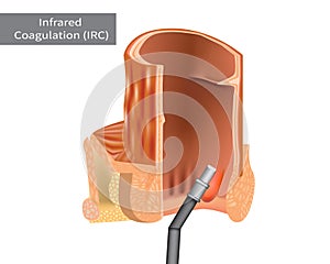 Infrared Coagulation Therapy for Hemorrhoids photo