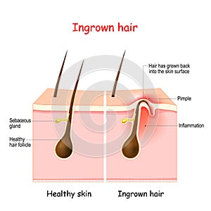 Ingrown hair