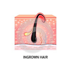 Ingrown hair. Hair has grown back into the skin surface after shaving. Formation of skin acne or pimple