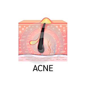 Ingrown hair. Hair has grown back into the skin surface after shaving. Formation of skin acne or pimple. Anatomy of hair and skin.