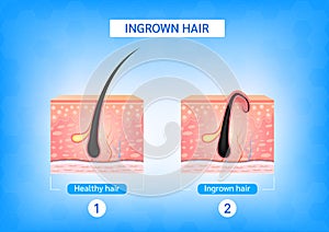 Ingrown hair. Hair has grown back into the skin surface after shaving. Formation of skin acne or pimple. Anatomy infographics of h