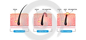 Ingrown hair. Hair has grown back into the skin surface after shaving. Formation of skin acne or pimple. Anatomy infographics of h