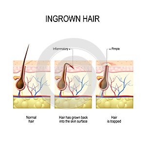 Ingrown hair after hair removal and shaving