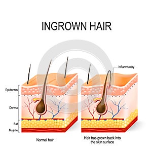 Ingrown hair