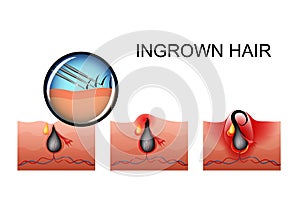 Ingrown hair, pimple ripening photo