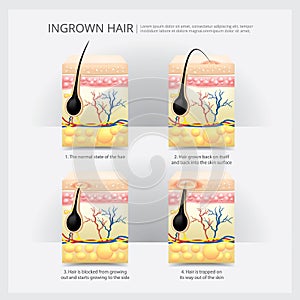 Ingrown Hair Structure