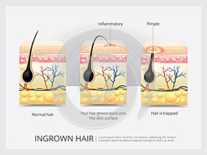 Ingrown Hair Structure