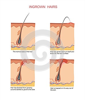 Ingrown hairs