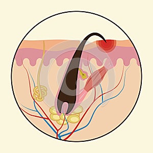 Ingrown hairs. Medical scheme of hair regrowth.