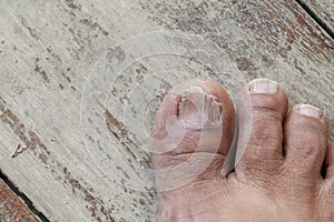 Ingrown nail Big toe selective focus, broken toenail on wooden