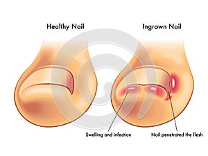 Ingrown nail photo
