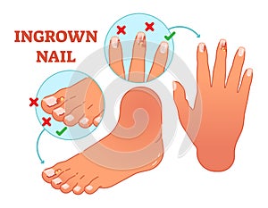 Ingrown nail medical vector illustration. photo