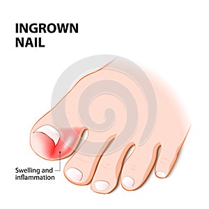 Ingrown nail. nail disease