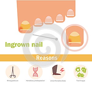 Ingrown nail. Vector.