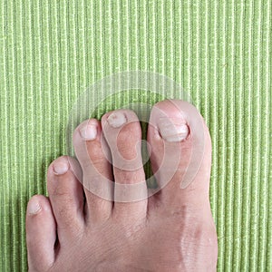 Ingrown toe nail