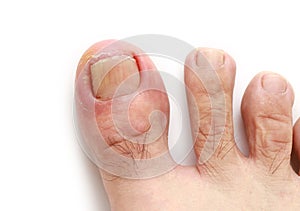 Ingrown toenail