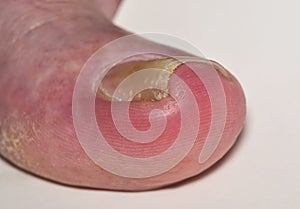 Ingrown toenail onychocryptosis on caucasian big toe.