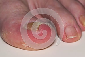 Ingrown toenail onychocryptosis on caucasian big toe Hallux, caused by fungal infection tinea unguium.