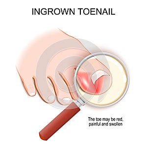 Ingrown toenail. Top view of a magnifying glass and Foot