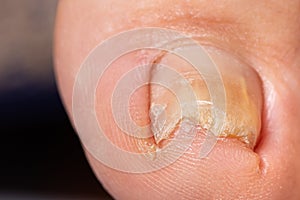 Ingrown toenail from wearing tight shoes. Nail fungus macro photo, onychomycosis, dermatomycosis, mycosis